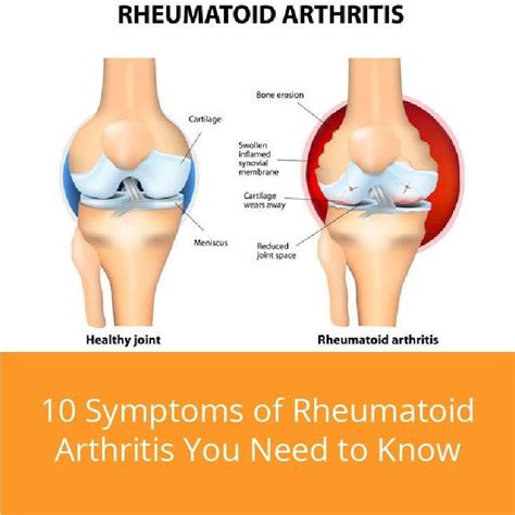 10 Symptoms Of Rheumatoid Arthritis You Need To Know A Lot About