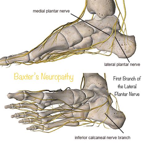 Lateral Plantar Nerve Entrapment SpringerLink, 46% OFF