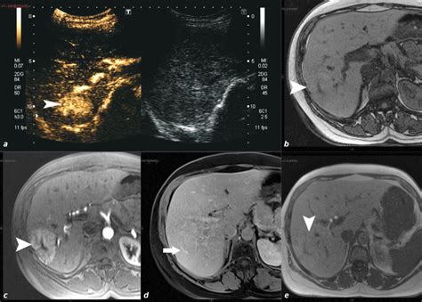 Imagerie Des Tumeurs B Nignes Du Foie Actualisation Fmc Hge