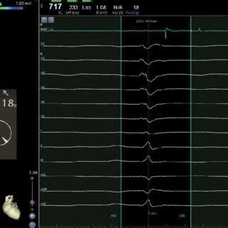 A Epicardial Bipolar 3D Mapping Late Potential Recorded At The Border