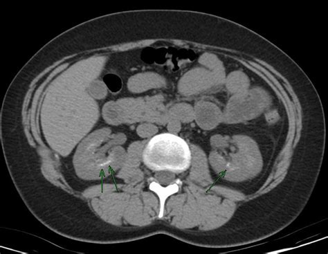 Medullary Sponge Kidney