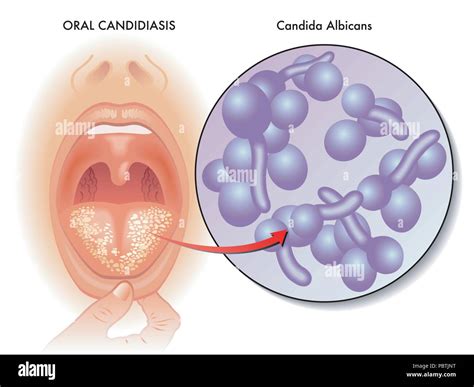 Candida Albicans Mouth