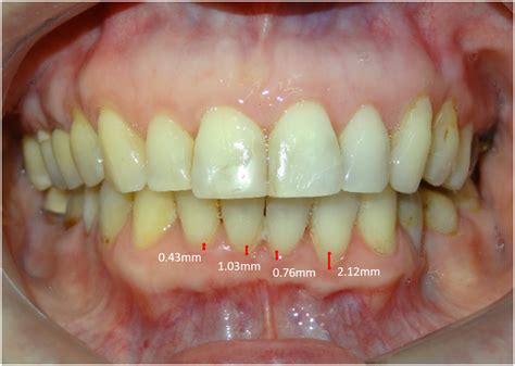 Gingival Recession In Mandibular Anterior Teeth In Patients With Class