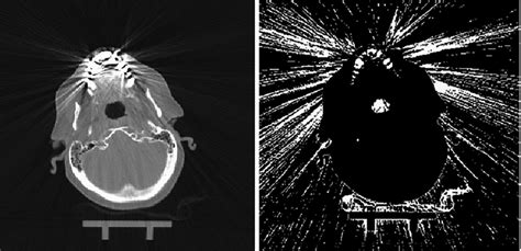 Original Computed Tomography Ct Image With Dental Streaking Artefacts