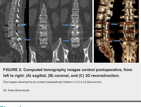 Pdf Giant Invasive Intradural Extramedullary Lumbar Schwannoma A