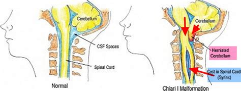 Chiari Malformation Causes Symptoms Prognosis Diagnosis Treatment