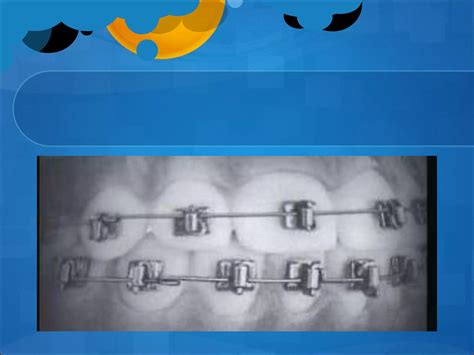 Fixed Orthodontic Appliances Ppt