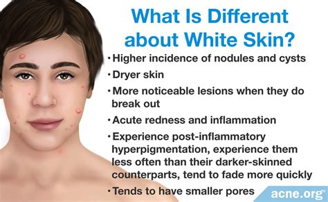 White Skin and Acne - Acne.org