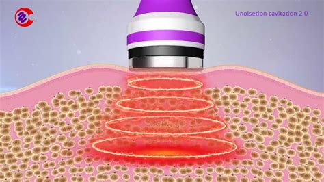 How Does Unoisetion Cavitation Ultrasound 2.0 Work? | Ultrasonic ...