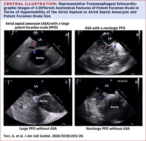 Atrial Septal Aneurysm Shunt Size And Recurrent Stroke Risk In