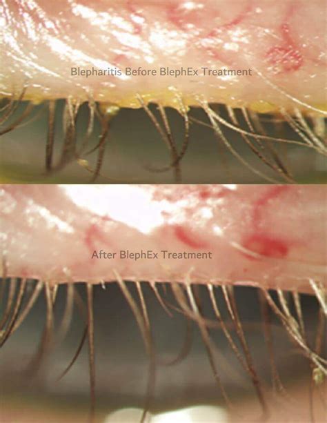 Blephex® And Blepharitis Bc Your Local Optometrist