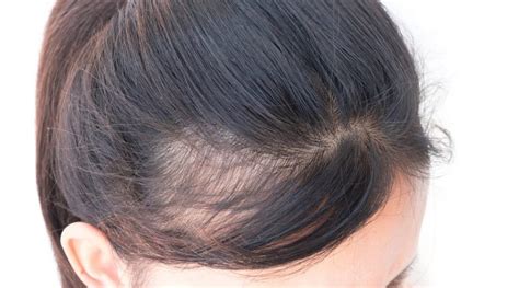 Women and Bald Spots: What to Do? | Blog | Keranique