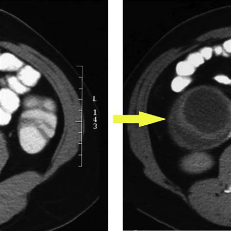 Contrast Enhanced Abdominal Computed Tomography Ct Showing A Cystic Download Scientific Diagram