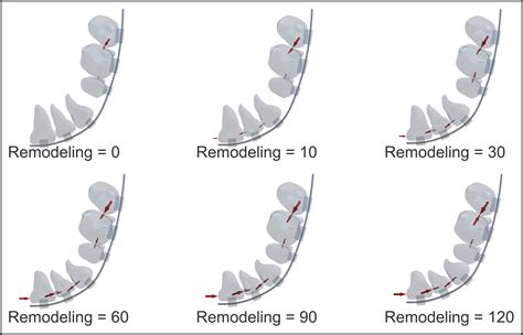 Numeric Simulation Model For Long Term Orthodontic Tooth Movement With Contact Boundary