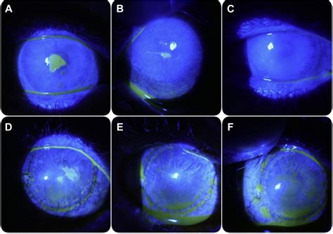 In Vivo Evaluation Of Corneal Nerves And Epithelial Healing After Treatment With Recombinant