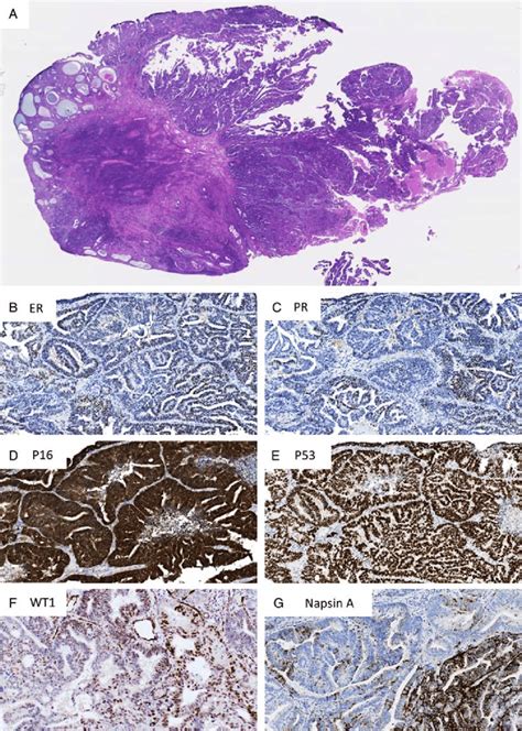 A Case Of Polypoid Serous Endometrial Intraepithelial Carcinoma Showing