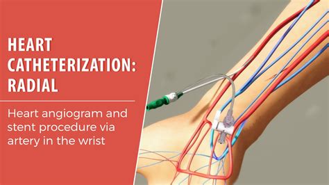 Heart Catheterizationradial Cardiovisual Trusted Patient Education Platform