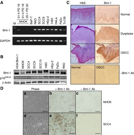 Elevated Bmi Expression Is Associated With Dysplastic Cell