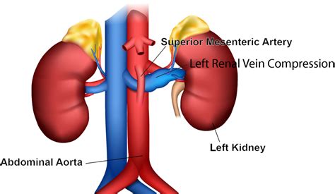 Nutcracker Syndrome 2 Vein Specialists Of The South