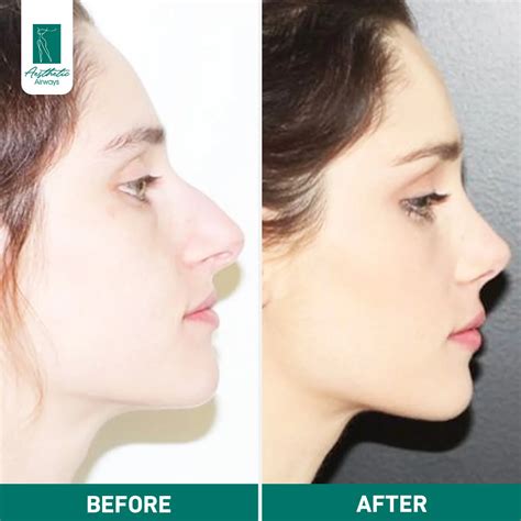 Rhinoplasty Surgery Turkey Nose Job Surgery Turkey