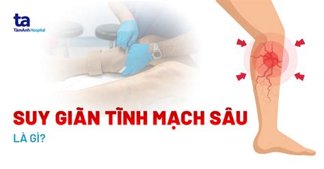 Suy giãn tĩnh mạch sâu chi dưới Nguyên nhân triệu chứng và điều trị