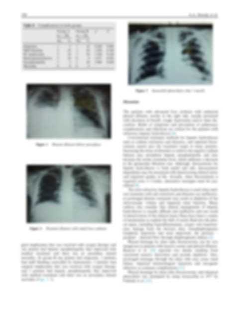 SOLUTION Chemical Pleurodesis By Small Bore Catheter In Hepatic