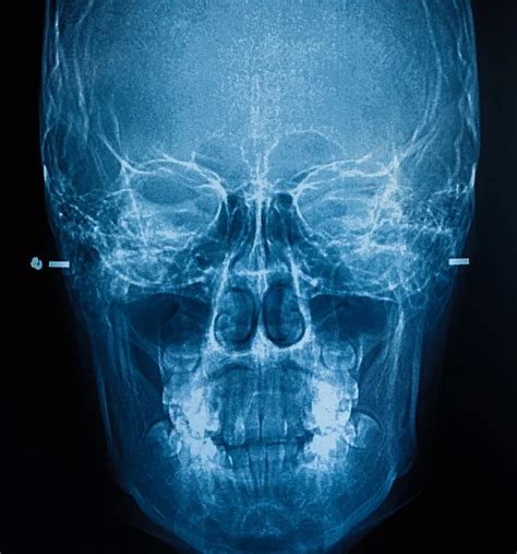 Sinusitis. film x-ray skull AP ( anterior - posterior ) show infection and inflammation at ...