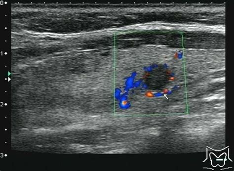 Papillary Thyroid Cancer Ultrasound