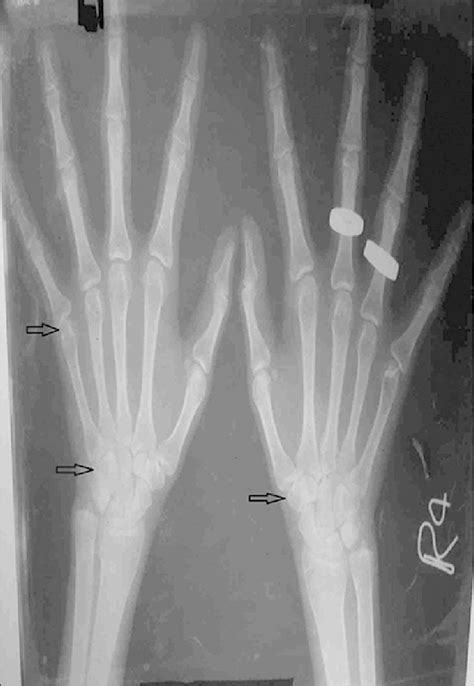 X‑ray of both hands showing lucency within bilateral triquetral bones ...