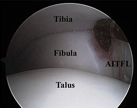 The anterior-inferior tibiofibular ligament (AITFL) in this left ankle ...