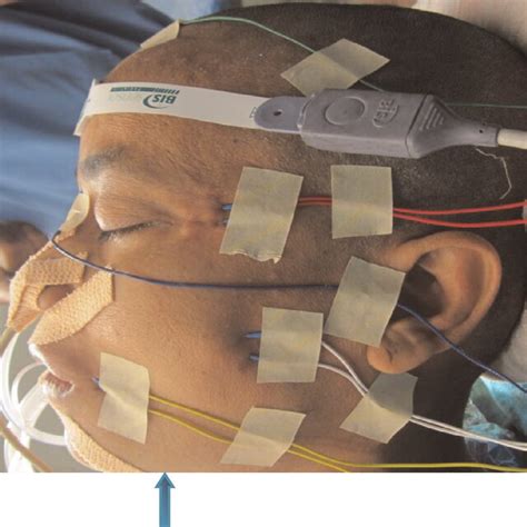 Bipolar Direct Nerve Stimulating Electrodes Probe Download Scientific Diagram