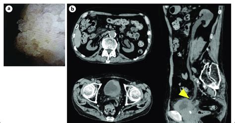 Cystoscopy And Abdominal Ct Findings At The Initial Diagnosis A Download Scientific Diagram