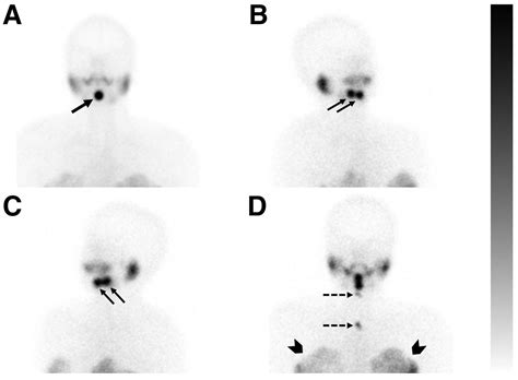 Thyroid Scintigraphy And Spectct In A Rare Case Of Dual Ectopic