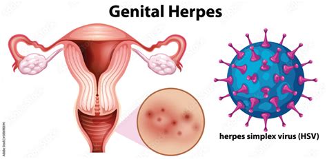 Vetor De Genital Herpes With Herpes Simplex Virus Hsv Do Stock