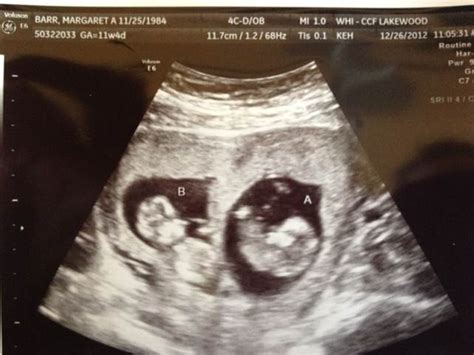 Twin Parenting: NT Twin Ultrasound