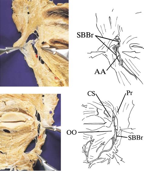 Supraorbital Nerve Cadaver