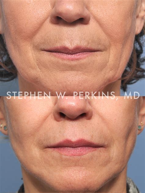 Lip Enhancement – Indianapolis Plastic Surgeons | Dr. Stephen Perkins, MD