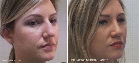 Rinoplastica Tecnica Costi E Post Operatorio Pallaoro Medical Laser