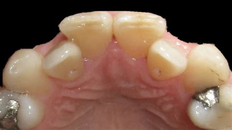 How Braces Work Crossbite Of Lateral Incisors 9 Months Treatment