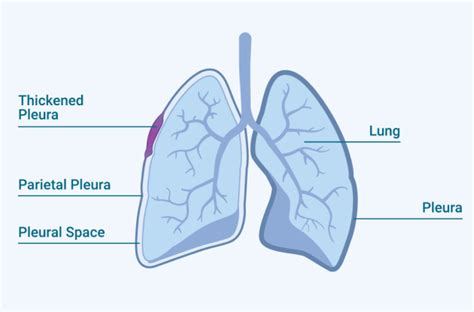 Pleural Thickening | Mesothelioma Guide