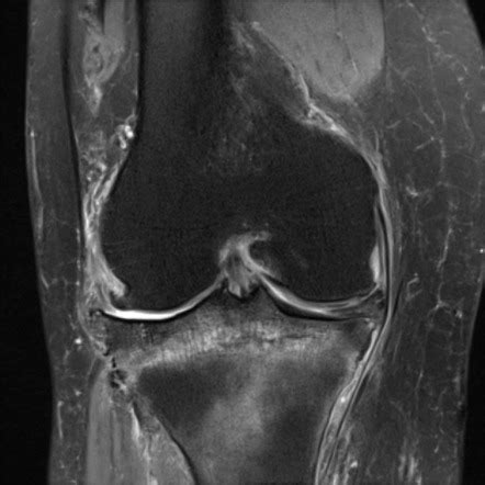 Tibial Plateau Fracture Mri