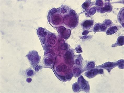 Transbronchial Needle Aspirate Papanicolaou Stain X40 Showing A Lung