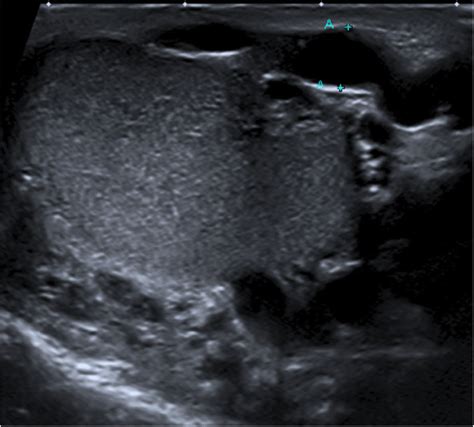 Ultrasound Of The Left Testis 5 Months Prior To The Er Visit During A Download Scientific