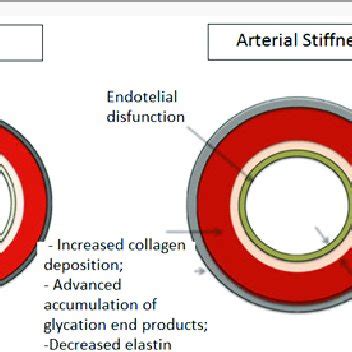 (PDF) Arterial Stiffness and Coronary Artery Disease