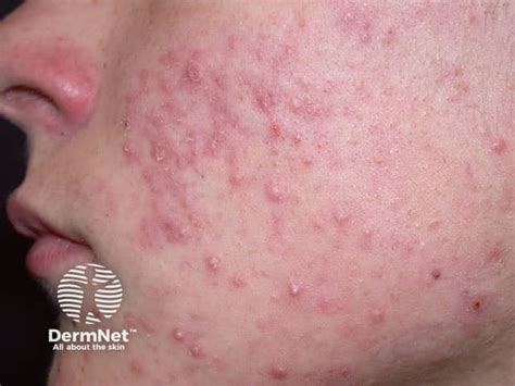 Acne Vulgaris Features Types And Treatments — Dermnet 2024