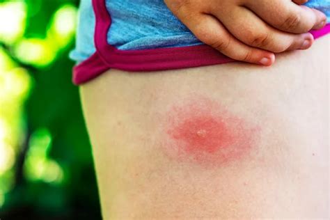 Signs And Symptoms Of A Tick Bite ActiveBeat Your Daily Dose Of