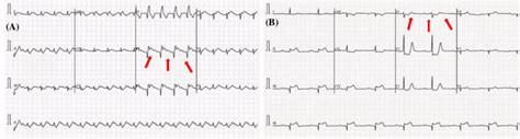 Illustration of two examples of ECG classes: abnormal ECG trace image ...