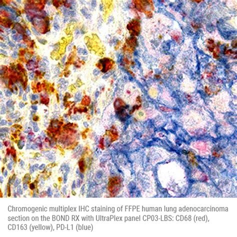 Cp03 Lbs Multiplex Panel Human Cd68cd163pd L1 Chromogenic Multiplex Ihc For Bond Rxrx M