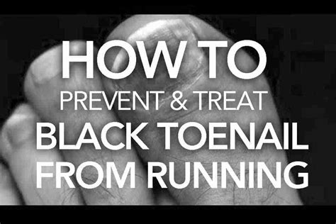 How to Prevent and Treat Black Toenail from Running - Train for a 5K.com