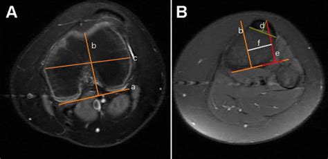 A And B Cartilaginous Tibial Tubercle Trochlear Groove Tt Tg